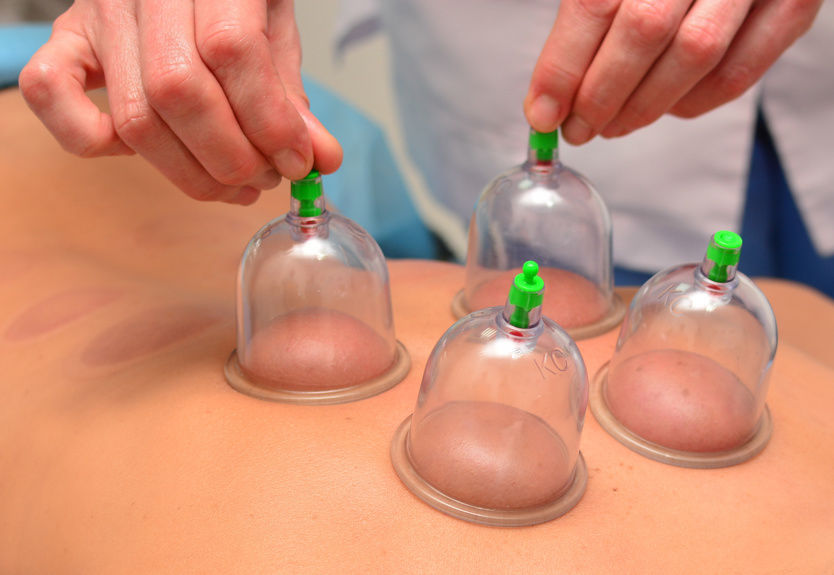 cupping