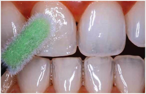 fluoride-therapy-treatment-service-500x500